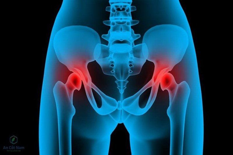 Thoái hóa khớp háng