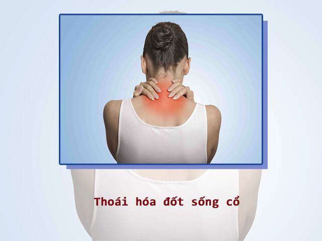 Thoái hóa đốt sống cổ